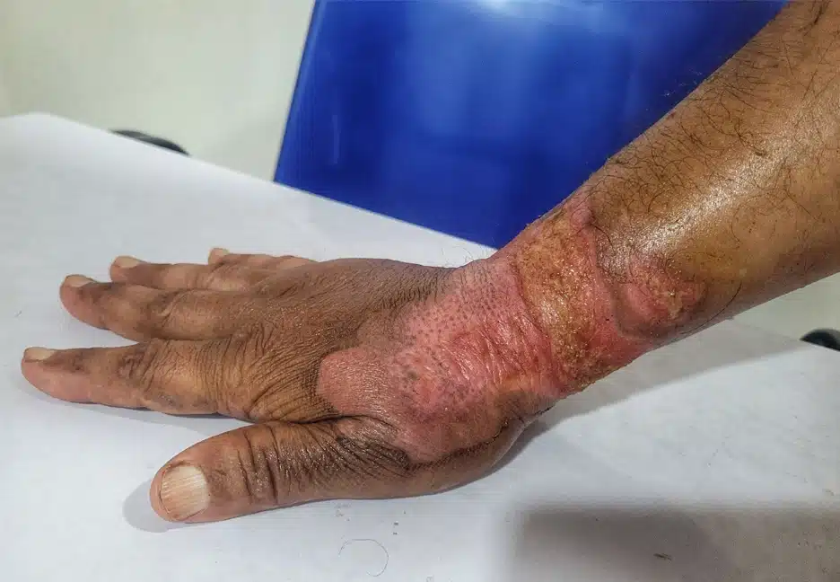 burned hand