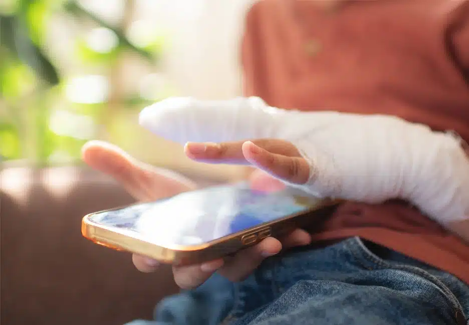 burned hand holding a cell phone