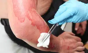 burn being treated